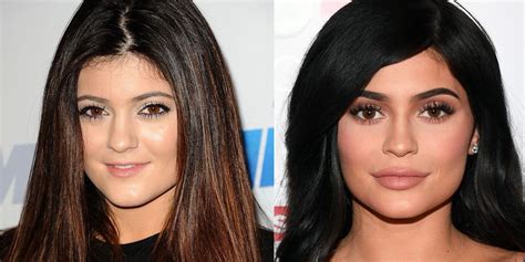 Plastic surgery before and after - 9 celebrities on what it's really like