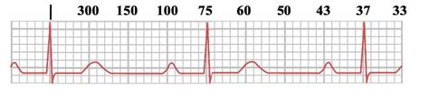 [最新] 300 150 100 75 ecg 365210-Ecg 300 150 100 75 - Gambarsaei4a