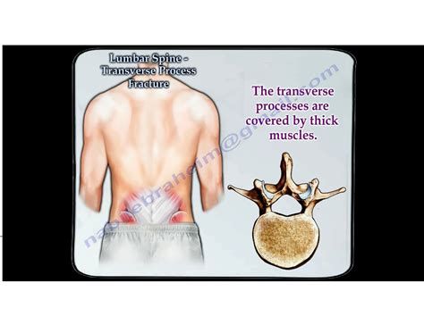 Transverse process fracture treatment - statproduct