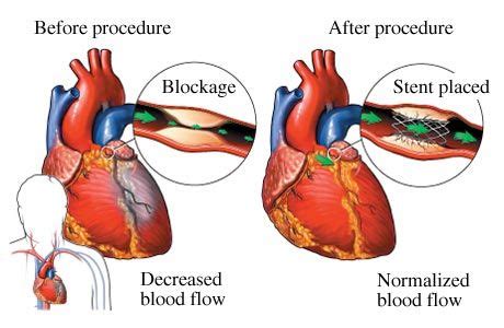 Coronary Artery Blockage | Understanding Stents and Treatment of Coronary Artery Blockages ...