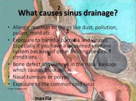 Paranasal Sinuses | Doovi