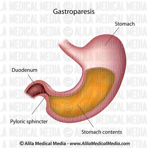 Alila Medical Media | Hartmann's procedure. | Medical illustration