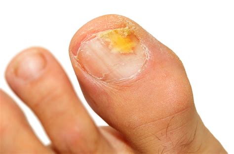 6 Tips To Stop Nail Fungus Before It Starts | | BlackDoctor