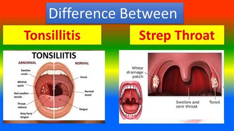 Difference between Tonsillitis and Strep Throat - YouTube