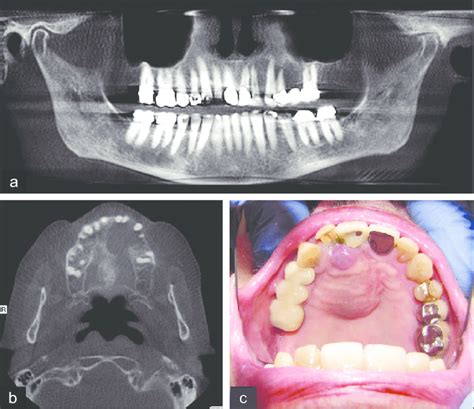 Maxillary Giant Cell Granuloma