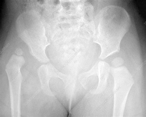 Hip Dysplasia in Child, X-Ray - Stock Image - C043/2867 - Science Photo Library