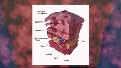 Necrotizing Fasciitis Groin