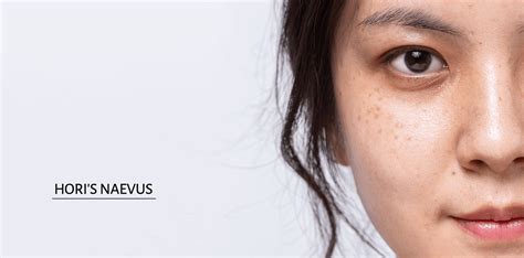 Hori's Nevus | Nevus of Ota | Treatment Options for This Pigmentation