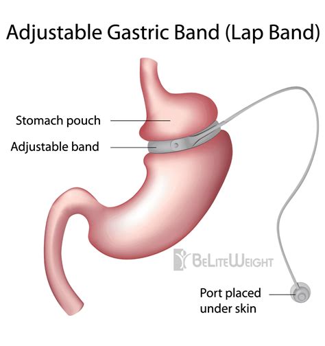 Adjustable, Laparoscopic Gastric Banding | Lap Band Procedures | Beliteweight