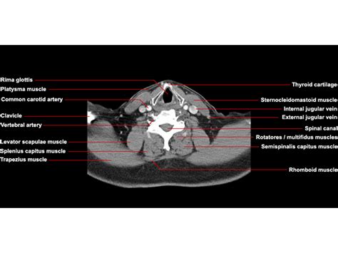 CT Neck Axial Anatomy – RADIOLOGYPICS.COM