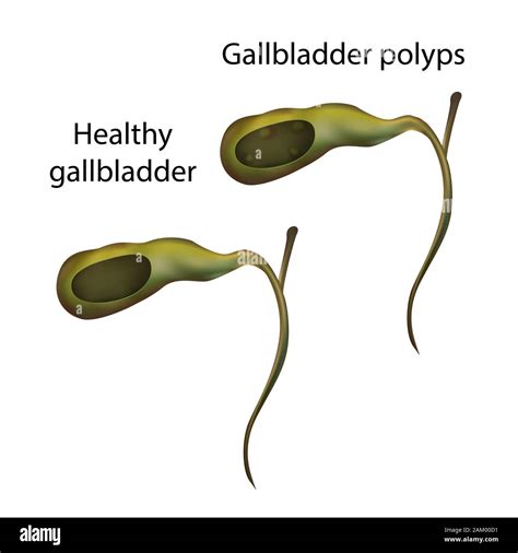 Gallbladder Disease Stages, Anatomy Vector Realistic White | lupon.gov.ph