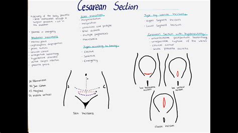 Cesarean Section Incision Types