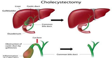 Cholecystectomy (Gallbladder Removal) : Conditions Treated, Procedure Types & Recovery