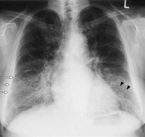 Fibrosing Lung Disease | Radiology Key