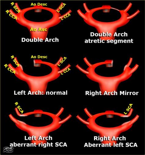 The Radiology Assistant : Vascular Anomalies of Aorta, Pulmonary and Systemic vessels