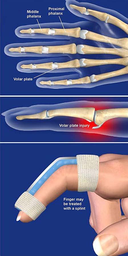 Volar Plate Injuries | Central Coast Orthopedic Medical Group