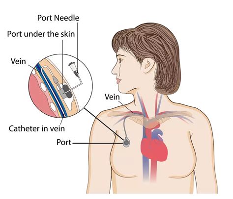 Chemo Ports for Breast Cancer: Types, Pictures, What To Expect | MyBCTeam