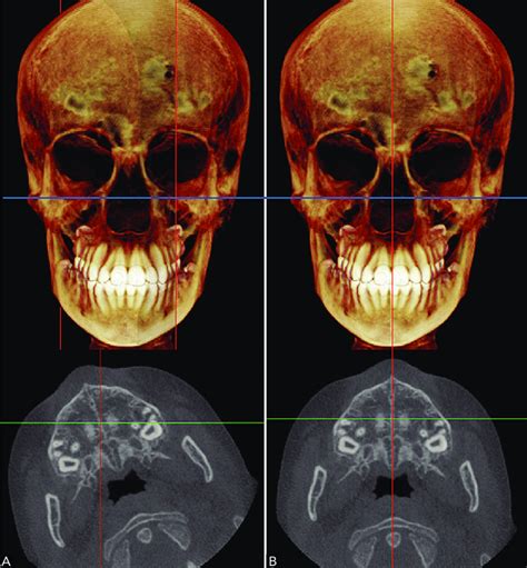 A) Example of a patient with the Frankfort Horizontal Plane... | Download Scientific Diagram