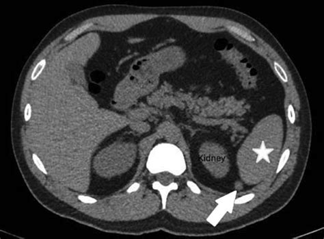 CT scan of accessory spleen at splenorenal ligament. Accessory spleen... | Download Scientific ...