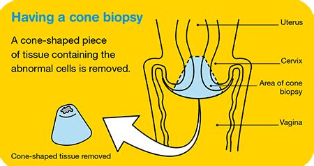 Diagnosing cervical cancer - Cancer Council Victoria