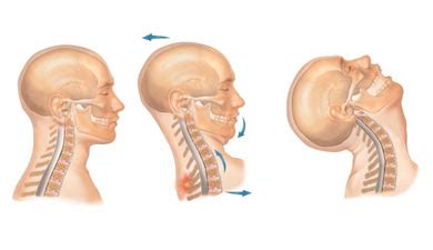 whiplash injury, rta, road traffic accident, slip disc, slipped disc ...