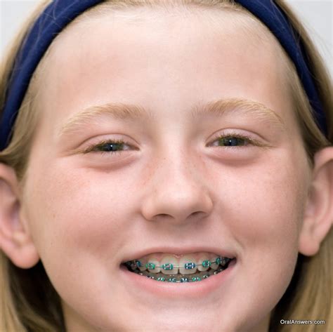 60 Photos of Teenagers with Braces - Robweigner's blog