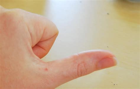 Beginning Of A Wart On Hand | www.pixshark.com - Images Galleries With ...