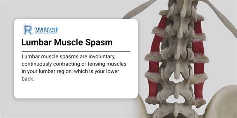 Lumbar Muscle Spasm: Symptoms, Causes, and Treatment