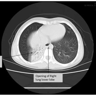 minimal bibasilar atelectasis on ct scan