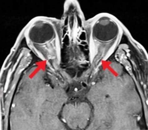 Bilateral Optic Neuritis: A Rare Complication of Mumps | Cureus