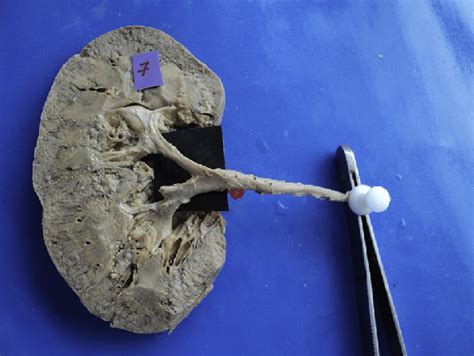 The infundibula of major calyx are directly continuous with ureter and... | Download Scientific ...