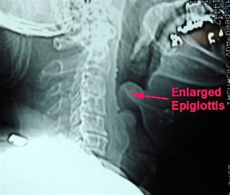 A case of acute Epiglottitis in an Adult Leukemia Patient - Radiology Imaging