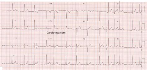 Curso ECG: Fibrilación auricular