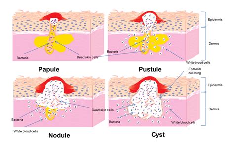 Aesthetic Treatment Singapore | Cystic Acne Treatments