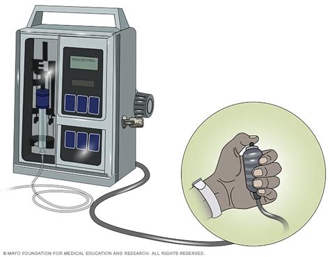 Patient-controlled analgesia (PCA) - Mayo Clinic