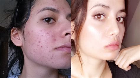 Tretinoin Before and After (12 Tips To Get The BEST RESULTS) - YouTube