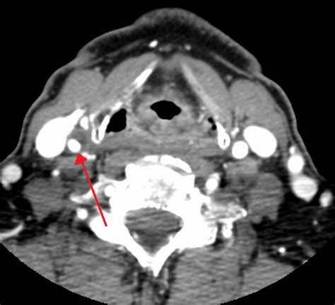 Carotid Stenosis; Carotid Artery Narrowing; Carotid Ulcer