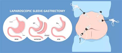 Gastric Sleeve (Sleeve Gastrectomy) Surgery | Booking Surgery