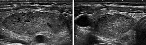 EU-TIRADS 4: intermediate-risk, mildly hypoechoic nodule with an oval... | Download Scientific ...