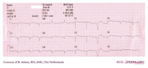 File:Dextrocardia.jpg - ECGpedia