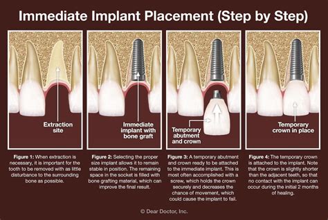 Immediate dental implant placement - step by step. | Dental, Dental implants, Dental implants cost