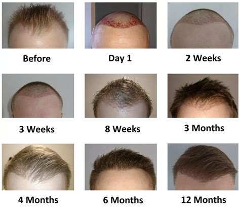 What is the 3-month progress after a hair transplant? | Hair Sure