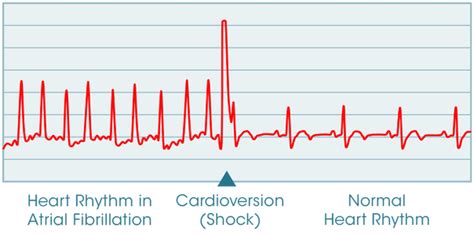 Being cardioverted | Arnold Zwicky's Blog