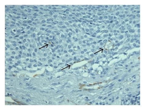 (a)–(c) Histopathological section of the biopsy showing the tumor as ...