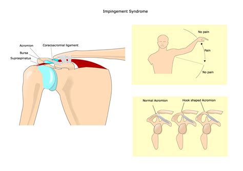 shoulder impingement - Larson Sports and Orthopaedics