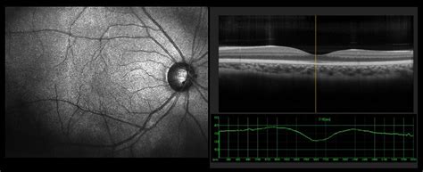 Retinal Tear Treatment Reading, PA - Retinal Detachment Info