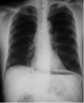 Pneumoperitoneum – Cupola sign – Toronto Notes