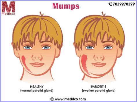 All the vital understanding about Mumps