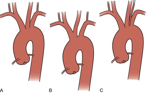 Brachiocephalic Artery | Thoracic Key