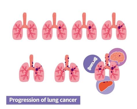 Lung Cancer Stages - NJ, CT, and MD – Regional Cancer Care Associates